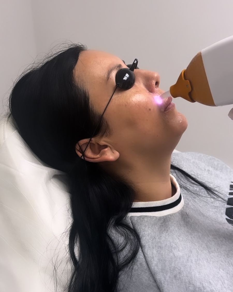 Upper lip laser hair removal on a client wearing protective eyewear