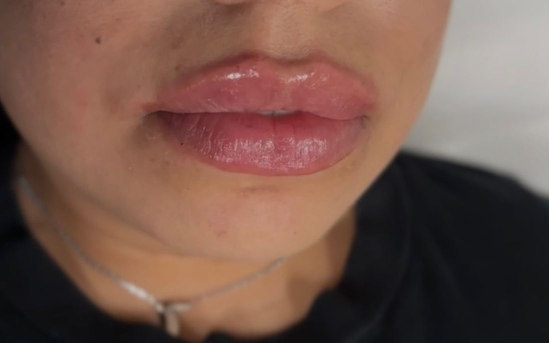 Lip filler result on a Latina Body Contour Spa client