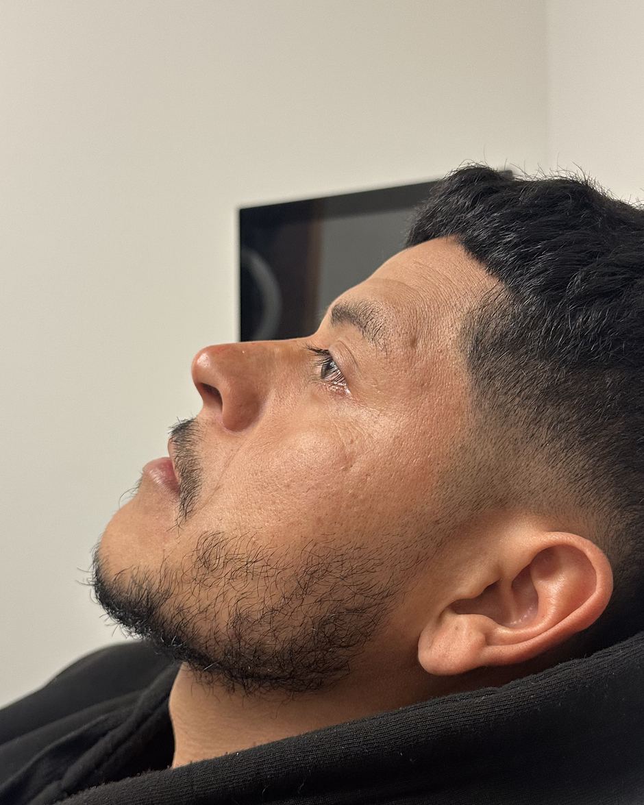 The same client's side profile right after nose filler