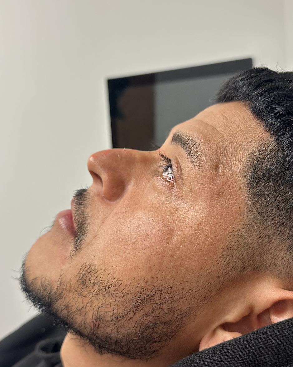 Side profile of a client's nose before nose filler at Latina Body Contour Spa